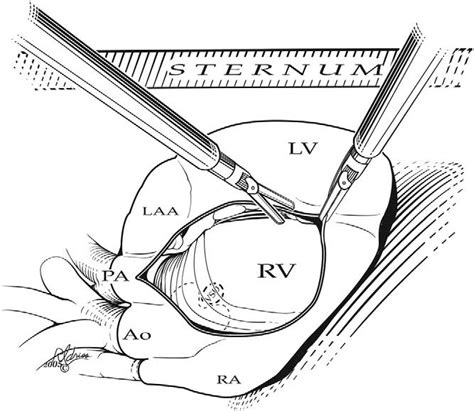 Robotically Assisted Pericardiotomy Rv Right Ventricle Ra Right