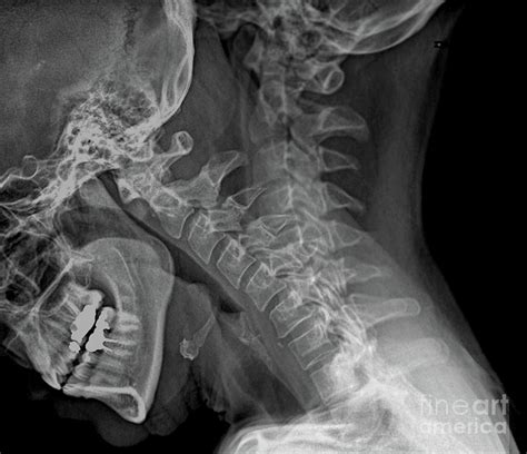 Flexion Of The Cervical Spine Photograph By Zephyr Science Photo Library