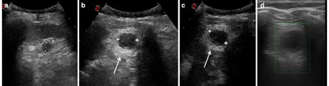 A Ultrasound Detects The Accessory Spleen Close To The Lower Pole Of