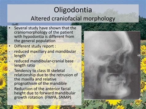 PPT - Oligodontia PowerPoint Presentation, free download - ID:1872529