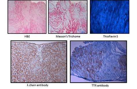 Endomyocardial Biopsy With Different Staining Of Cardiac Amyloidosis