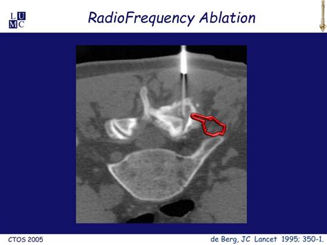 Ppt Ct Guided Radiofrequency Ablation In Patients With Spinal