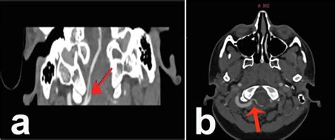 Surgicoanatomical Aspect In Vascular Variations Of The V3 Segment Of Vertebral Artery As A Risk