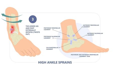 Ankle Syndesmosis Injuries Sports Medicine Leichhardt