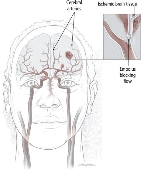 Stroke Overview Harvard Health