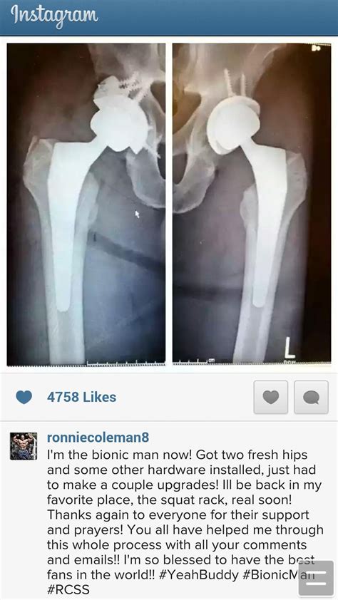 √ Ronnie Coleman Leg Injury