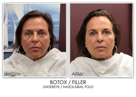 Nasolabial Fold Archives Skin Rejuvenation Clinic Skin Rejuvenation