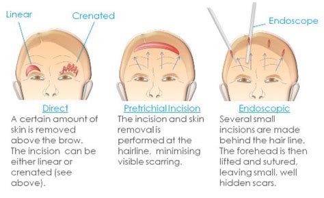 Brow Ptosis