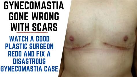 FIXING A DISASTROUS GYNECOMASTIA CASE PERFORMED BY NON QUALIFIED DOCTOR