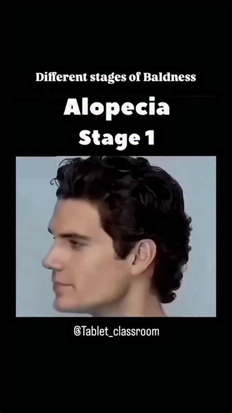 norwood scale stages male pattern baldness diagram