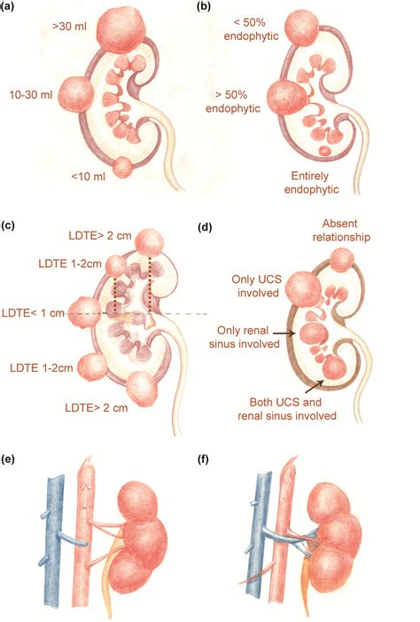 3d Nephrometry Score Elements A Tumor Volume Classification B