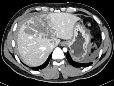 Contrast-enhanced CT scan showing Grade IV liver laceration. | Download ...