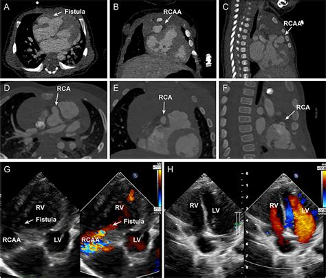 Frontiers Case Report Isolate Congenital Coronary Artery Fistula