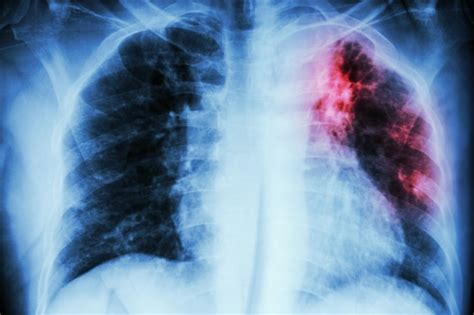 Premium Photo | Pulmonary tuberculosis