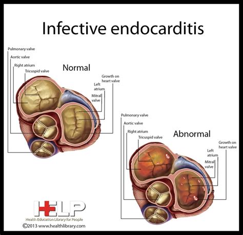 Infective Endocarditis Cardiac Nursing Pinterest