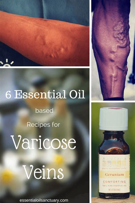 6 Essential Oil Based Remedies For Varicose Veins