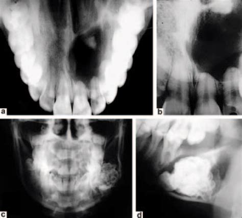 Radiographic Examination First Case A Occlusal Radiograph And B Download Scientific