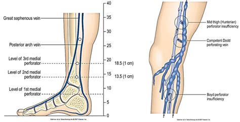 Perforator Veins - Advanced Laser Vein Care