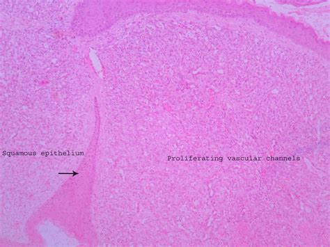 Capillary Hemangioma Histopathologyguru