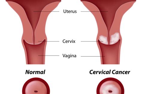 Abnormal Pap Smear - International Women's Clinic