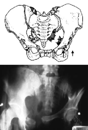 Lateral Compression Type Iii Posterior Iliac Blade With Both Rami Download Scientific