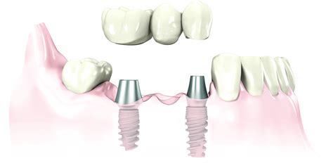 Legacy Dental | 3-unit-implant-bridge_ti-abutments_1l_red