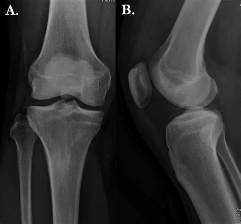 Fixation Of Femoral Attachment Anterior Cruciate Ligament Avulsion