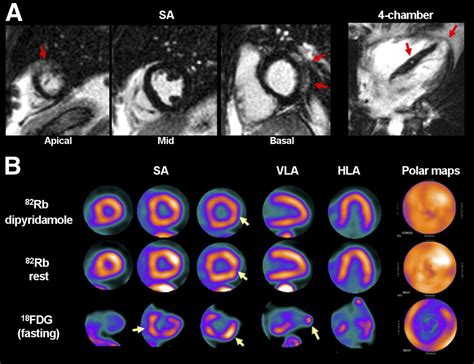 Nuclear Medicine Scan Heart