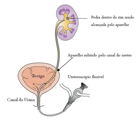 Laser Para Tratamento De C Lculos Urin Rios One Clinic