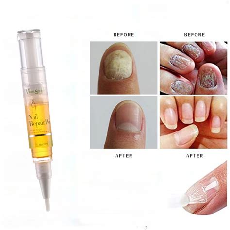 5ml Nail Cuticle Oil Pen Onychomycosis Paronychia Nail Treatments Anti ...