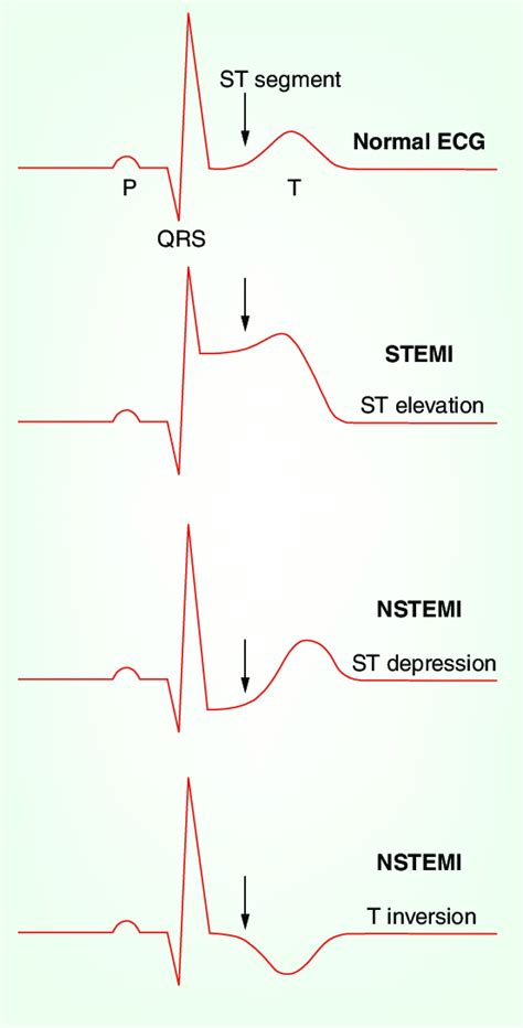 Nstemi Vs Stemi On Ekg