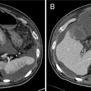 Follow Up Abdominal CT Scan A Abdominal CT Scan Taken After 1 Month