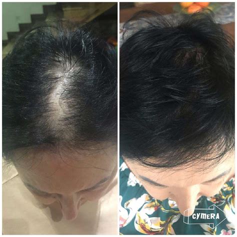 Alopecia Treatments – Charlene Hogan Skin