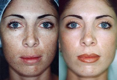 What You Should Know About Chemical Peels (Before and After Pics)