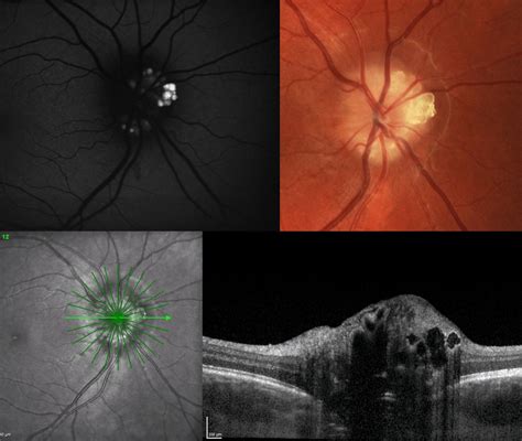 Optic Disc Drusen Prevalence 15 Times Higher in RP Patients