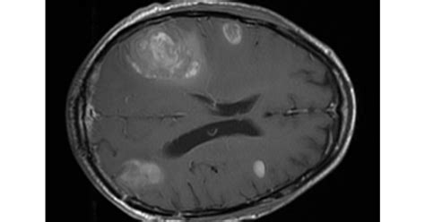 Tackling Brain Metastases - Melanoma Research Alliance