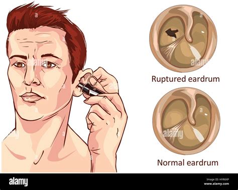 Tympanic Membrane Tube Stock Vektorgrafiken Kaufen Alamy