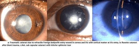 A Fluffy Cataract With Anterior Capsule Rupture B Rosette Cataract