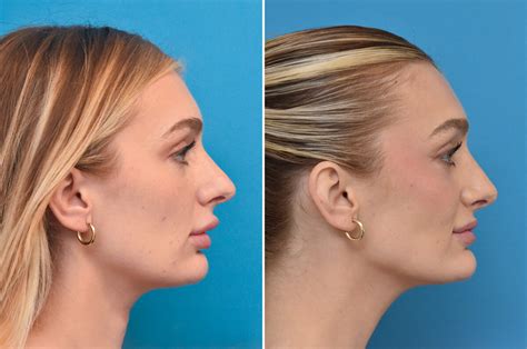 Rhinoplasty 101 Your Guide To Correcting A Crooked Nose