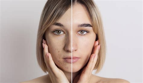 Elimina Le Cicatrici Da Acne Youmedical