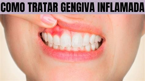 Use Esse Rem Dio Caseiro E Acabe As Gengivas Inflamadas Rapidamente