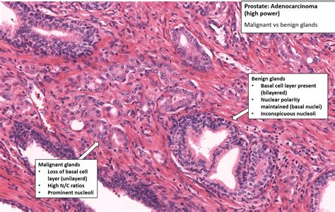 Prostate Carcinoma Histology