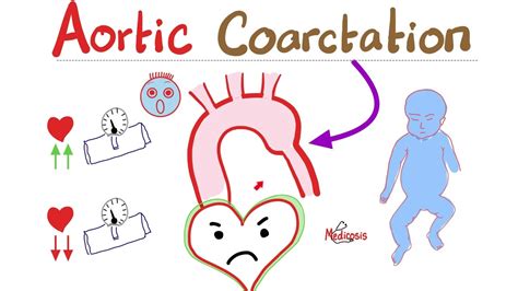 Coarctation Of The Aorta Cardiology Series Types Symptoms Signs Diagnosis And Treatment