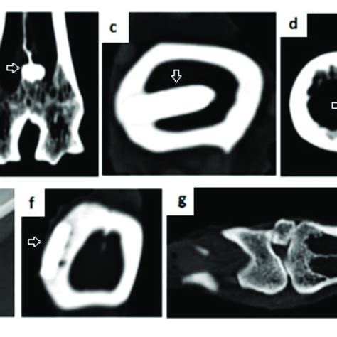 X-ray and CT scans 6 months after implantation. (a) X-ray of metatarsal ...