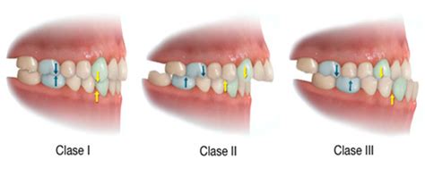 La Maloclusión Dental Y Cómo Corregirla Clínica Dental En Barcelona