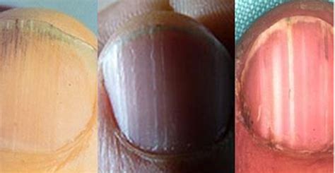 8 Health Warnings Your Fingernails May Be Sending Natural Cures Not