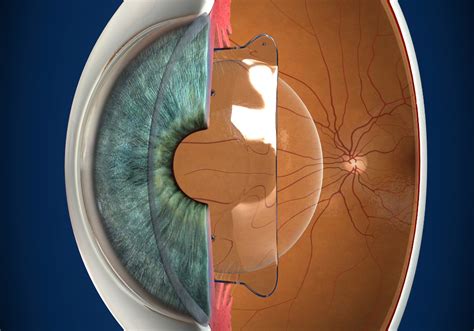 Implantable Collamer Lens Alternative To LASIK Eye Surgery