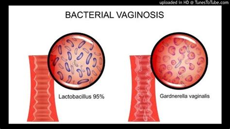 Bacterial Vaginosis BV Bacterial Identification Of The Vaginal