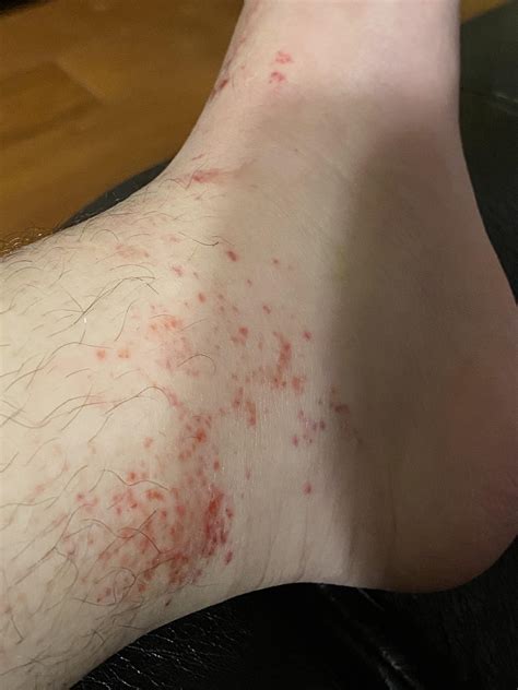 Finally Got Cast Off After 8 Weeks But These Red Dots Rash Was Left What Is It And How Can I