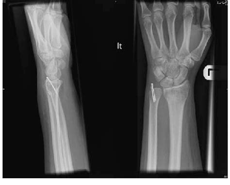 Ulnar Styloid Fracture Splint